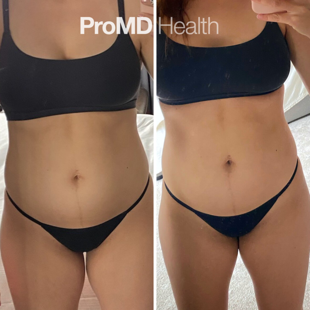Emsculpt