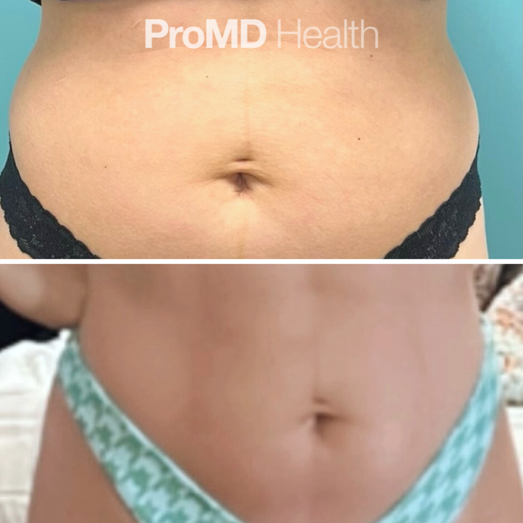 Emsculpt
