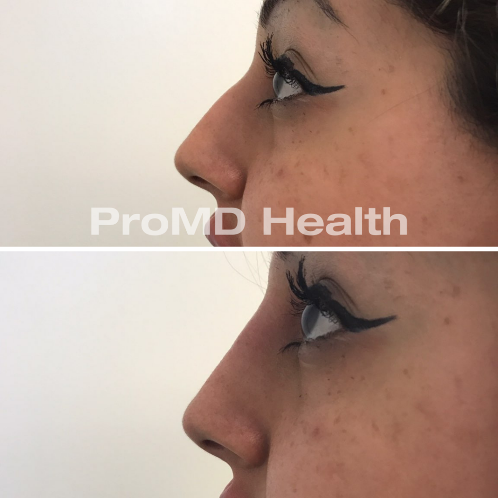 Filler - Non Surgical Nose Job