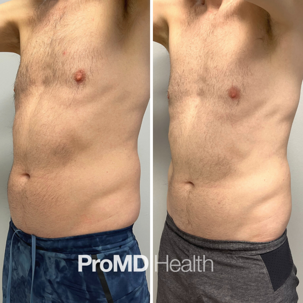 Emsculpt
