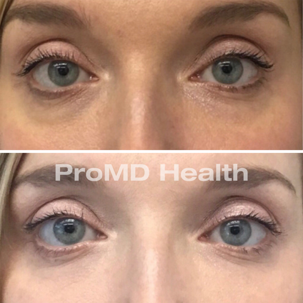 Filler - Under Eyes
