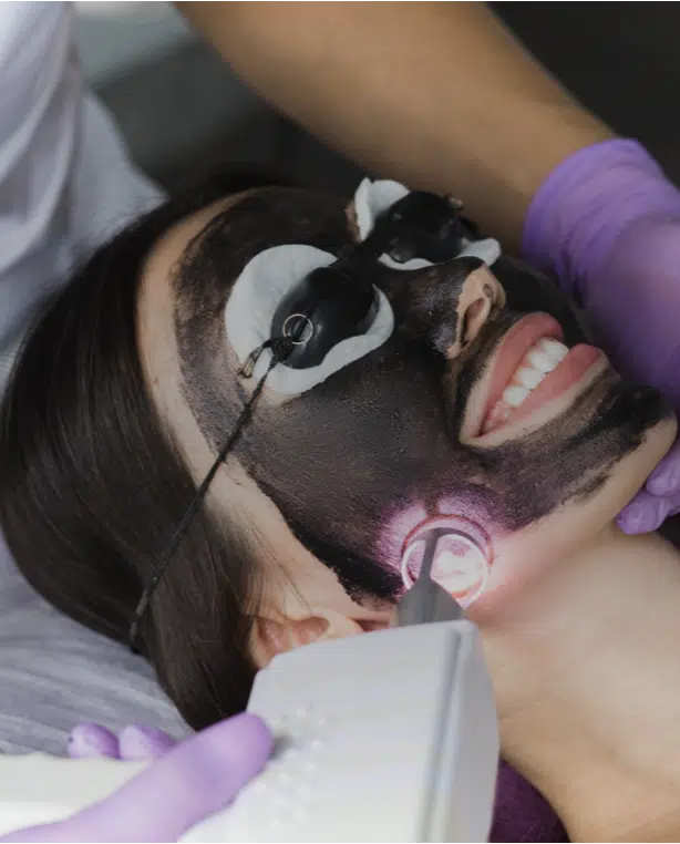 Microlaser Peel