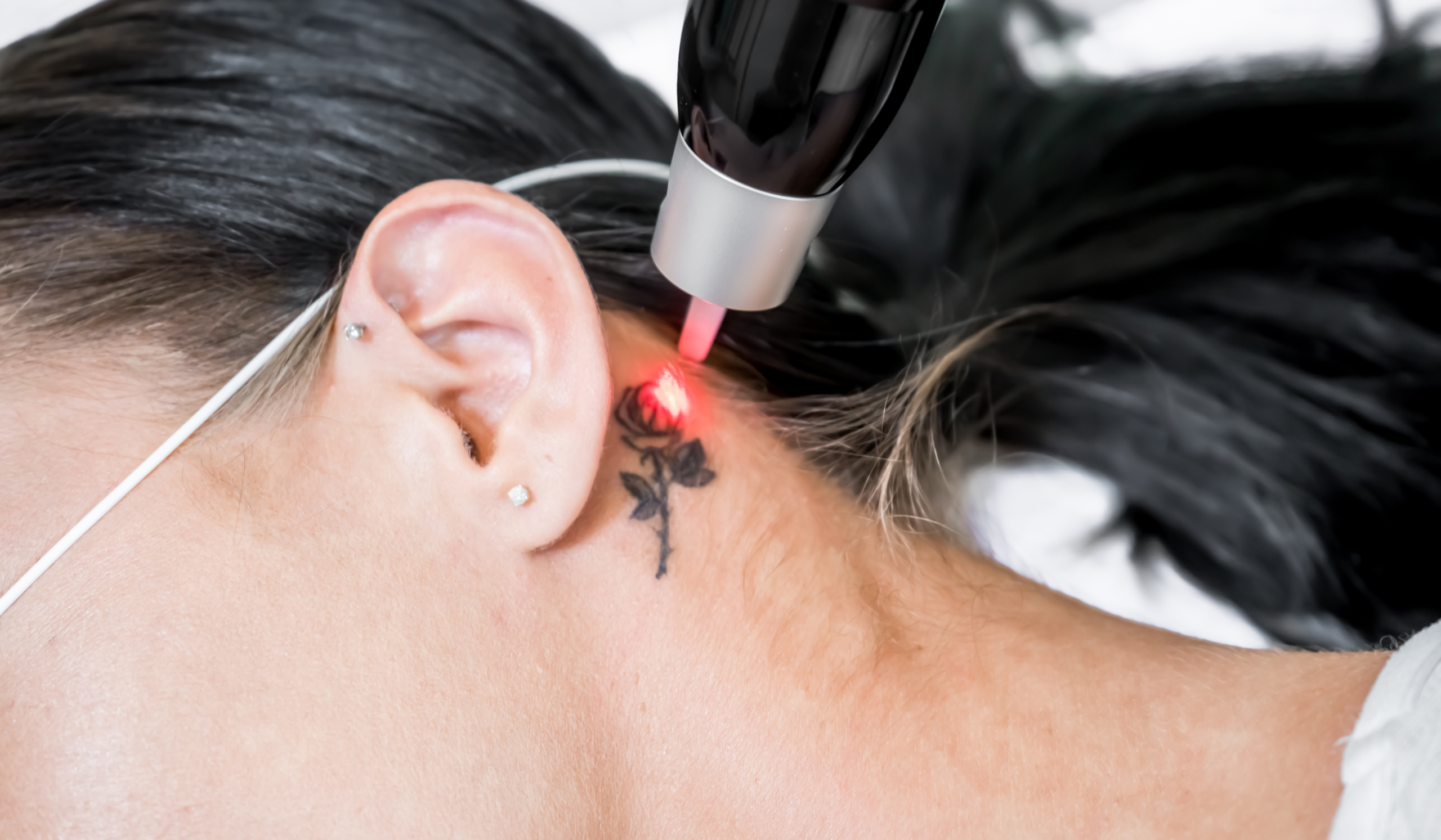 Tattoo Removal 2 at ProMD Health Desktop