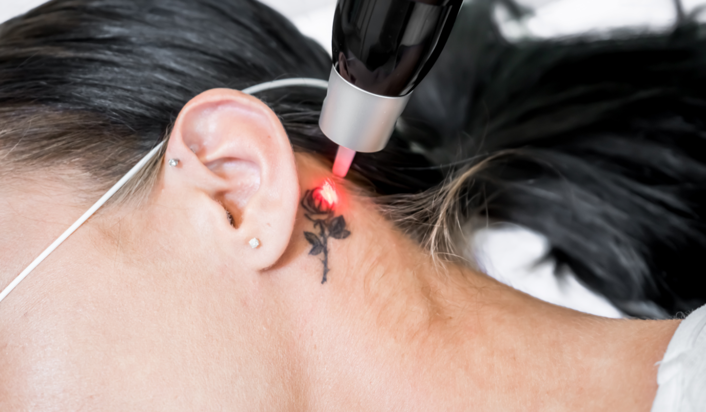 Tattoo Removal 2 at ProMD Health Tablet